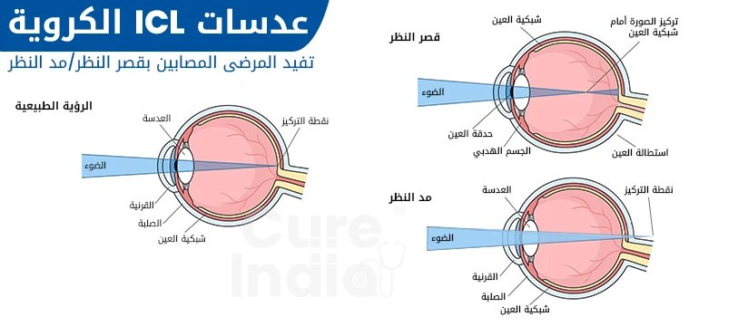 جراحة العدسات اللاصقة الكروية في الهند